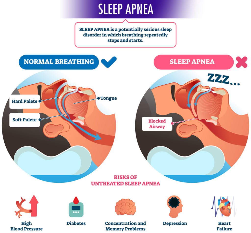 Sleep apnea diagram